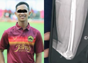 Tulang paha Wisnu Indra Kusuma yang retak dan foto terduga ajudan Pj Gubernur Jateng (dok. jpnn.com)