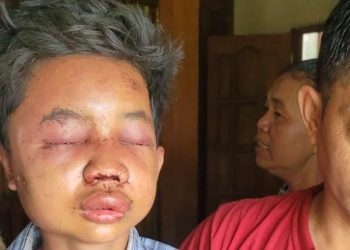 Begini Kondisi Terakhir Bocah 12 Tahun Korban Pengeroyokan di Boyolali Yang Dituduh Curi Celana Dalam