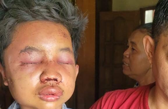 Begini Kondisi Terakhir Bocah 12 Tahun Korban Pengeroyokan di Boyolali Yang Dituduh Curi Celana Dalam