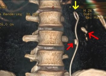 Selang tertinggal di tubuh pria asal Batang usai jalani operasi. (dok. istimewa)