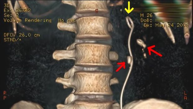 Selang tertinggal di tubuh pria asal Batang usai jalani operasi. (dok. istimewa)
