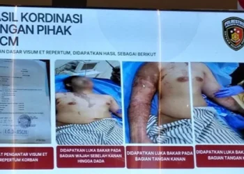 Kondisi Andrie Yunus stabil usai disiram air keras. (dok. istimewa)